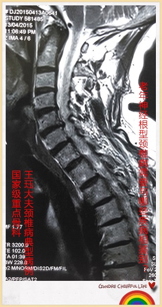 病例37:老年神经根型颈椎病需要与哪些疾病相鉴别?