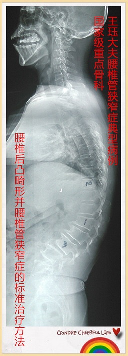 病例149:腰椎后凸畸形并腰椎管狭窄症的标准治疗方法