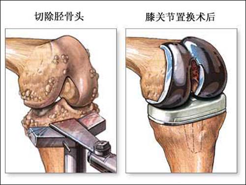 膝关节疼痛常见疾病病-骨关节病 (转载)