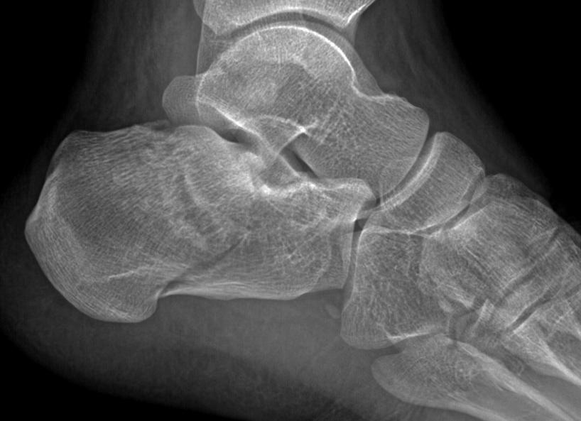 辅助检查:左踝关节正侧位x片:左跟骨骨折.