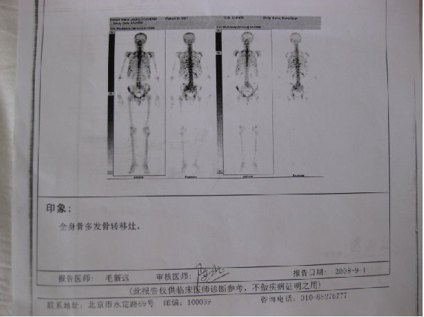 化疗法治疗晚期前列腺癌广泛骨转移的临床应用