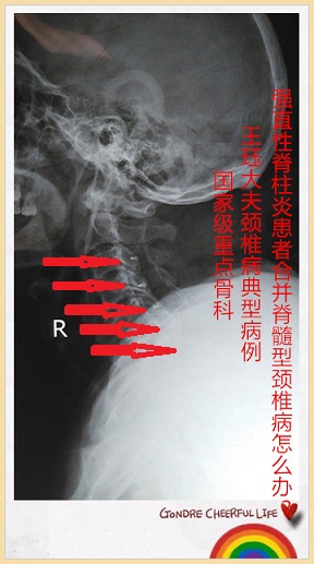 病例41:强直性脊柱炎患者合并脊髓型颈椎病怎