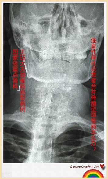 病例41:强直性脊柱炎患者合并脊髓型颈椎病怎么办?