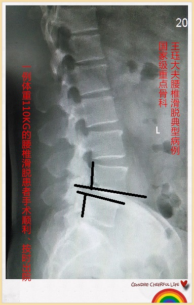 病例154:体重110KG的腰椎滑脱患者手术顺利