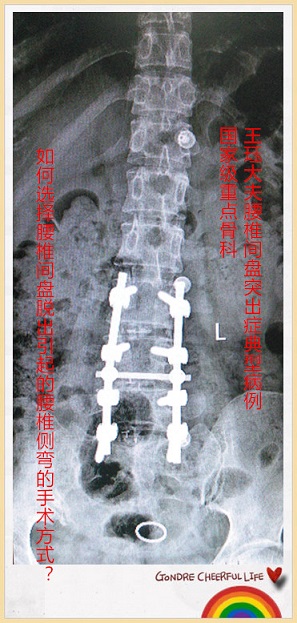 病例156:如何选择腰椎间盘脱出引起的腰椎侧弯的手术方式?