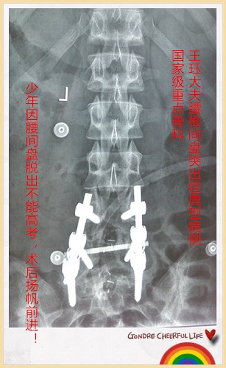 高三学生,体育生,由于训练等原因导致腰椎终板脱落,腰椎间盘脱出,严重
