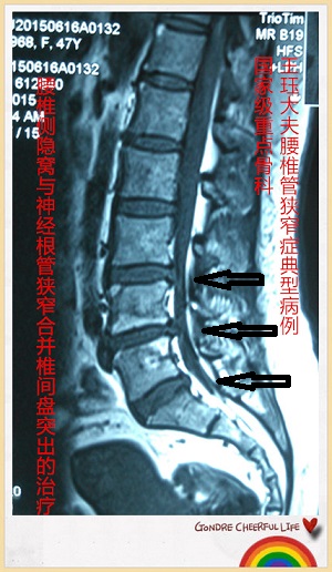 病例161:腰椎侧隐窝与神经根管狭窄合并椎间盘突出的治疗
