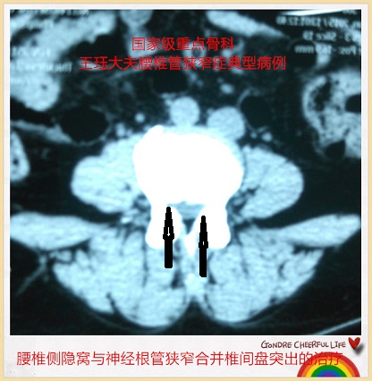 病例161:腰椎侧隐窝与神经根管狭窄合并椎间盘突出的治疗