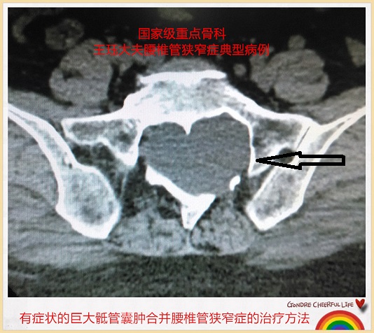 病例162:有症状的巨大骶管囊肿合并腰椎管狭窄症的治疗方法