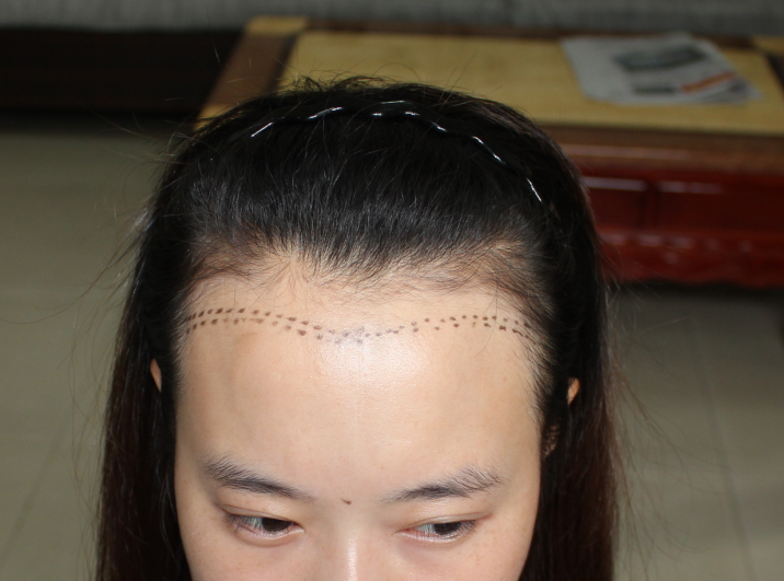 种植发际线是微整形里的璀璨明星_武汉科技大