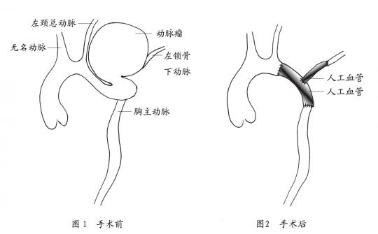 成功治愈1例罕见主动脉弓缩窄合并巨大主动脉瘤患者