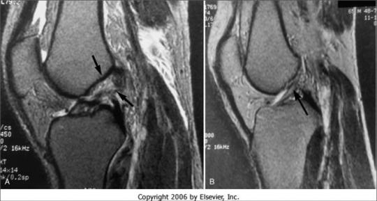 膝关节疾病的关节镜治疗之---前后交叉韧带断裂_北京地坛医院张强_寻医问药专家网