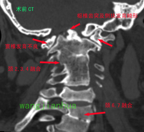王建华教授病例之12-合并复杂颅颈交界区复杂畸形的寰枢椎脱位