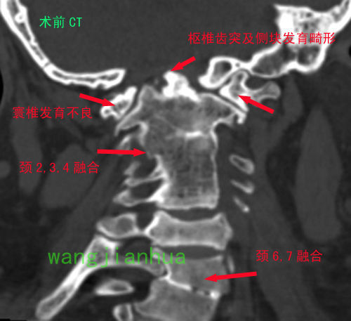 图4 术前三维ct显示,患者的枢椎齿状突及枢椎侧块发育畸形.