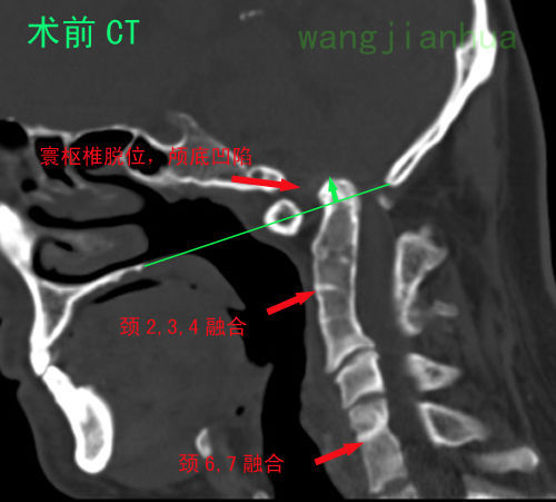 患者枢椎齿状突向上脱位,陷入枕骨大孔内