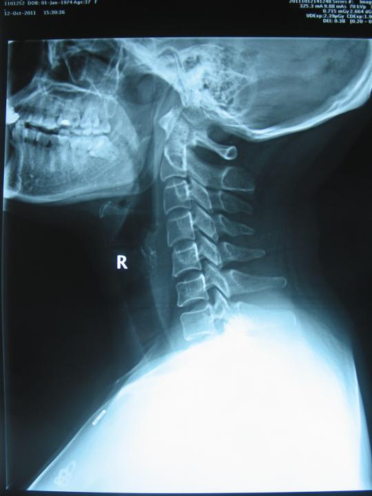阅片:颈椎曲度异常,可见颈椎小关节紊乱征象(图1x线片1,2,   颈椎正位