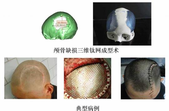 颅骨缺损综合症简介与手术治疗