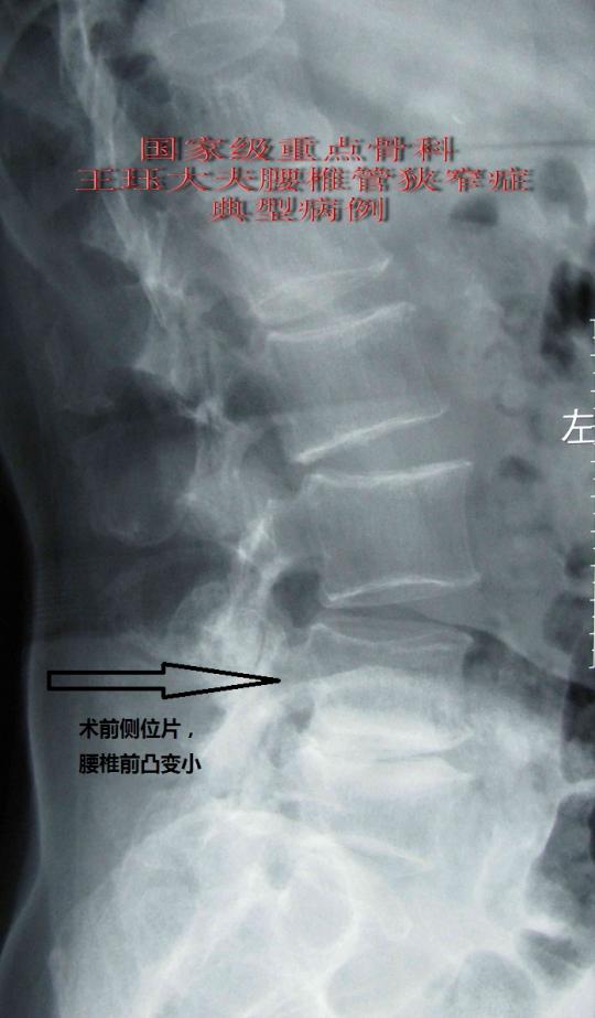 女,68岁,严重骨质疏松,腰椎管狭窄,滑脱伴椎体血