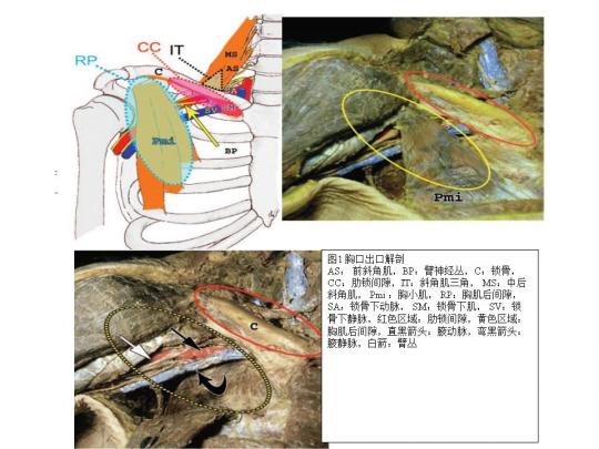 胸廓出口综合征的诊断与治疗