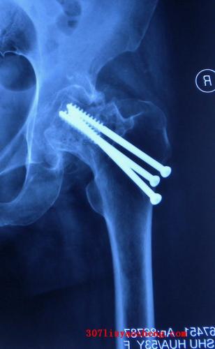 股骨头颈骨折导致创伤性股骨头坏死4期丧失保留已经股