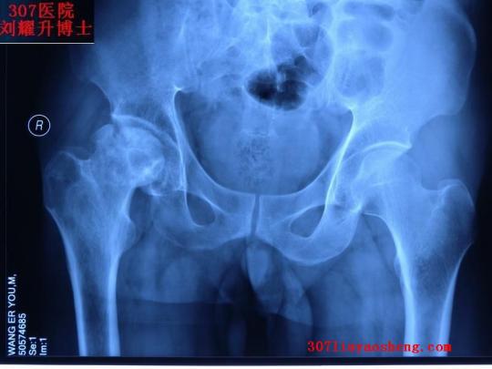 内蒙4期股骨头坏死患者成功行关节置换术 307医院刘耀升博士