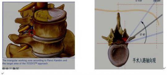 既往传统手术失败伴有神经周围疤痕形成及      腰椎手术失败