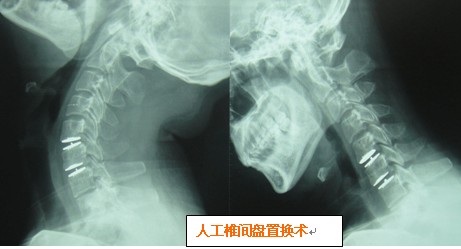 颈椎病后路开门手术近三周,现左后脑勺下边疼痛,头往左转拉着疼