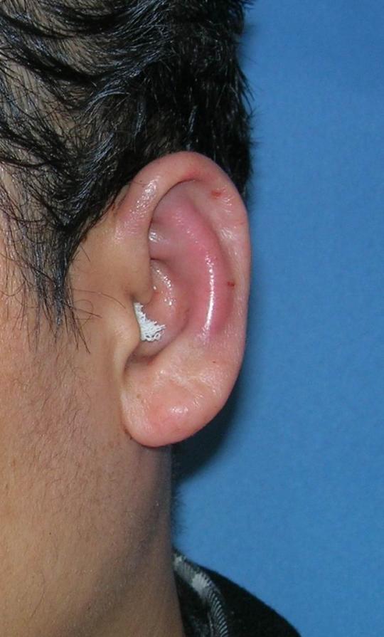 上认为招风耳属于畸形,但是很多国人认为耳大有福,并不介意耳朵招风