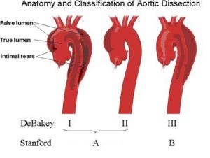 主动脉夹层的简介