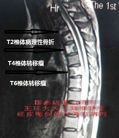 上胸椎多发转移瘤,河南省首例t2经皮单侧入路椎体成形