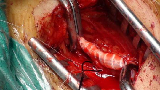 股动脉支架取出并股腘动脉人工血管转流手术治疗股动脉血管成形术