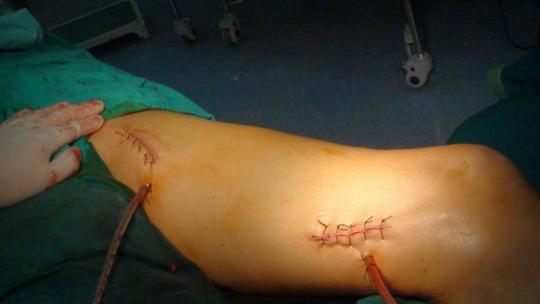 股动脉支架取出并股腘动脉人工血管转流手术治