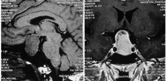 术前mri:垂体腺瘤,视交叉上抬.