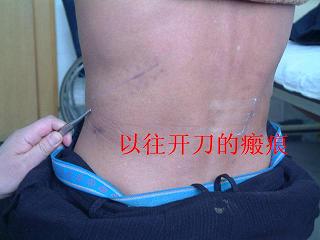 介绍一种微创治疗肾结石的方法------经皮肾镜碎石取石术_山东省交通医院魏巍_寻医问药专家网