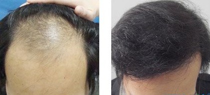 种植式毛发种植术 男人植发的首选_上海455医院李宇飞