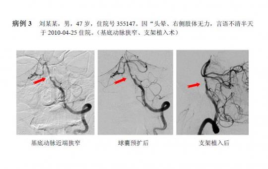 南京心脑血管造影和支架哪个医院做的好?