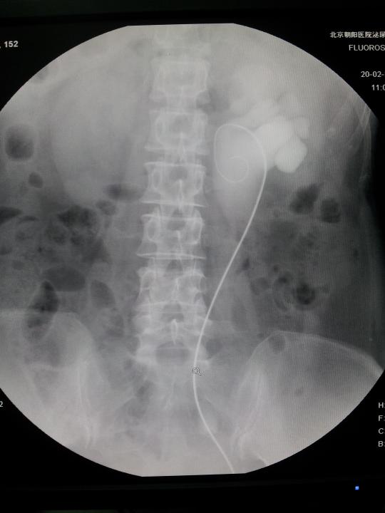 输尿管狭窄,迂曲,超滑,超硬导丝配合置双j管