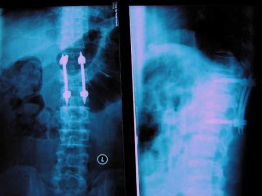 脊柱微创经典内固定技术---经皮椎弓根螺钉内固