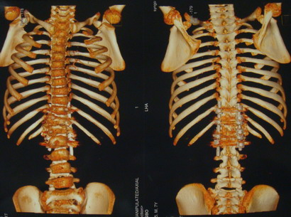 先天性脊柱侧弯-半椎体畸形