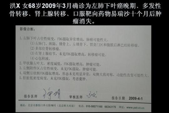 肺癌靶向治疗病例