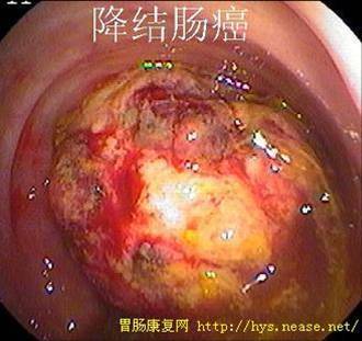 5,直肠癌或结肠癌:直肠癌或结肠癌也便血,但颜色多为暗红,有异味