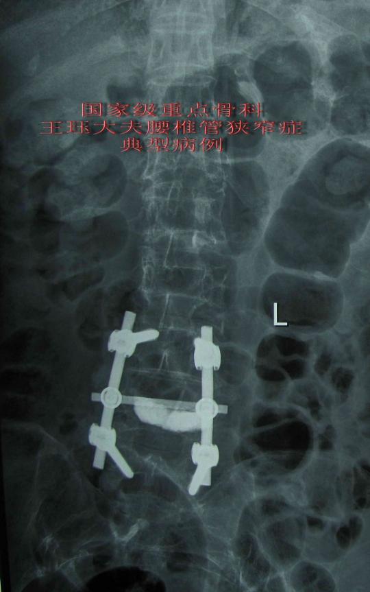 病例22:女,74岁,腰4椎体骨质疏松性骨折并椎管狭窄症