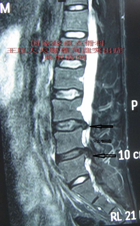 病例23:腰椎间盘脱出,髓核游离,马尾神经损伤,大小便障碍