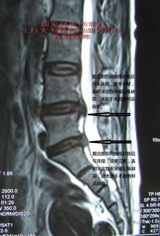 寻医问药专家网 王珏专家个人网站 文章列表 腰椎间盘突出典型病例