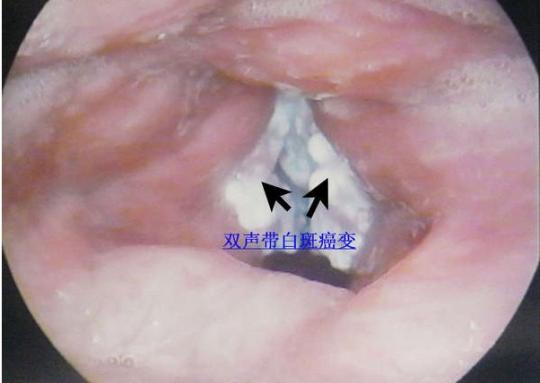 警惕声带白斑癌变