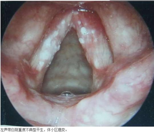 警惕声带白斑癌变