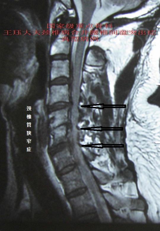 病例33:颈椎,腰椎管狭窄症微创无效再次手术完成颈腰椎减压