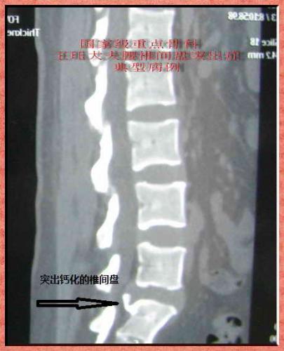 病例34:28岁,腰椎间盘突出并钙化,手术减压植入两枚融合器