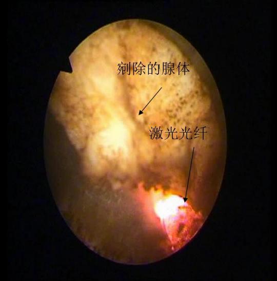 前列腺增生的2-微米激光微创手术治疗_武警总