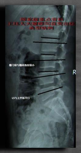 腰椎椎体形状总结(首创腰椎技术精要)